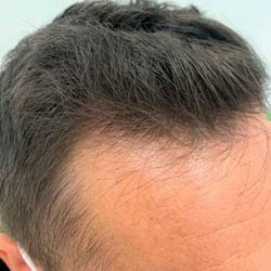 non-surgical-hair-loss-treatment-before-after-results-photos-dr-furqan-raja-007FR